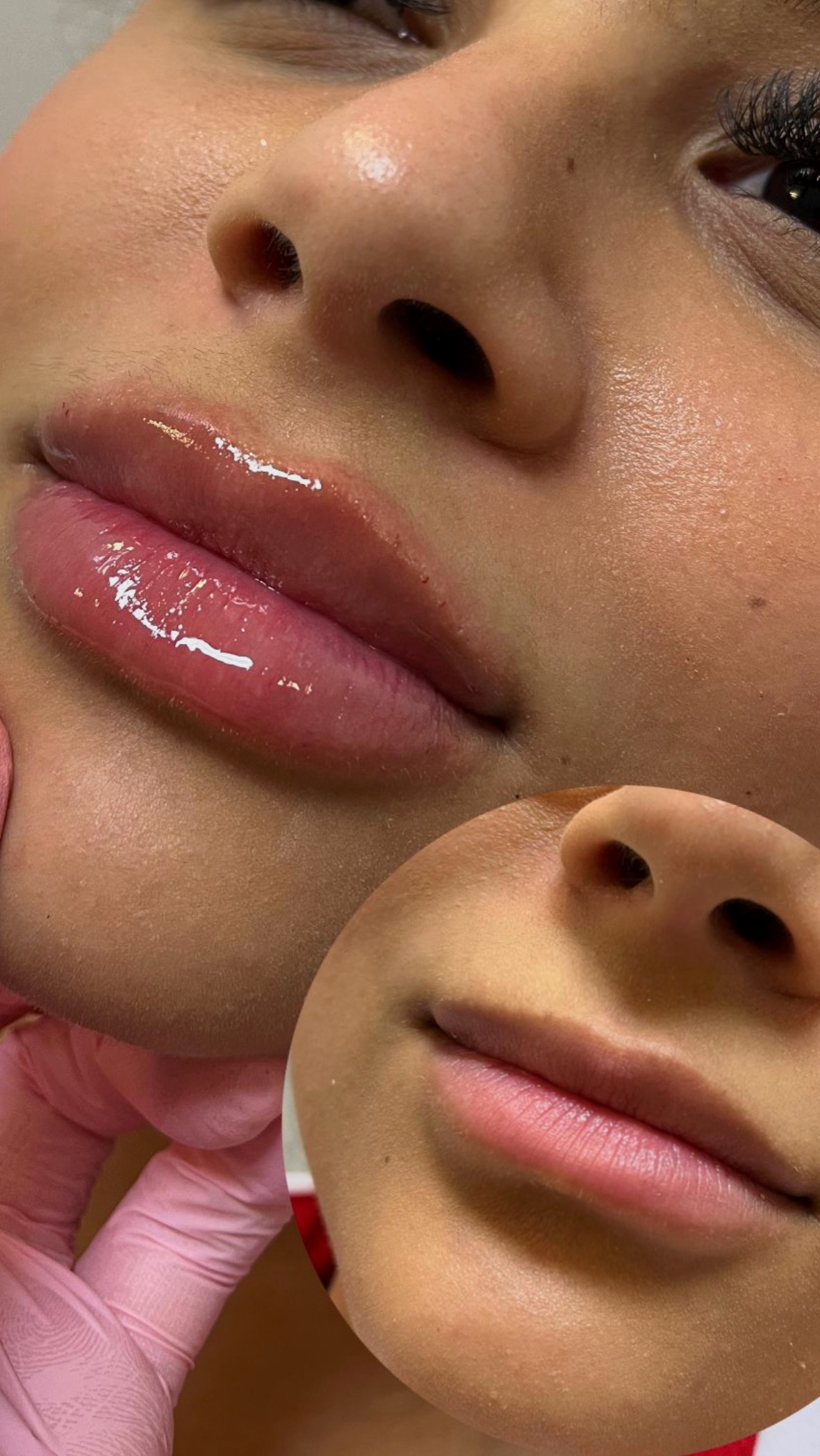 Preenchimento labial — resultado Black Shine