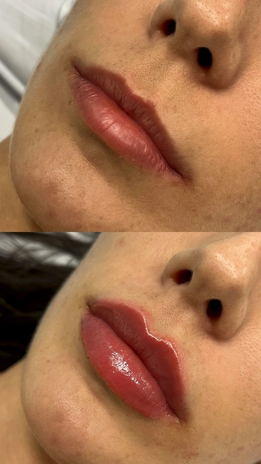 Preenchimento labial antes e depois — Black Shine